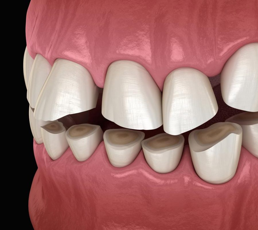 Dental Attrition (Bruxism) image