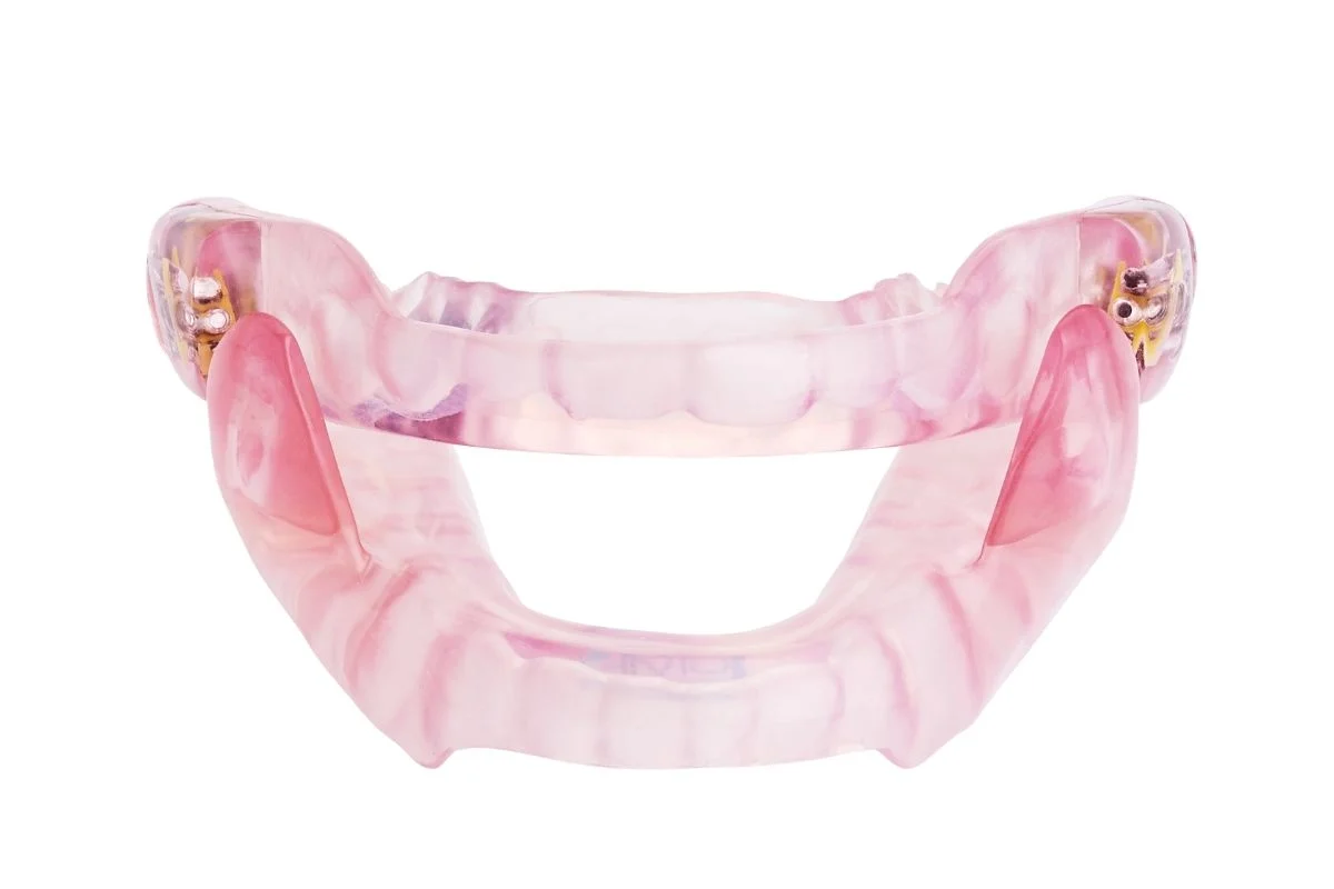 SomnoDent Flex, an den Patienten angepasste Unterkieferprotrusionsschiene (UKPS)